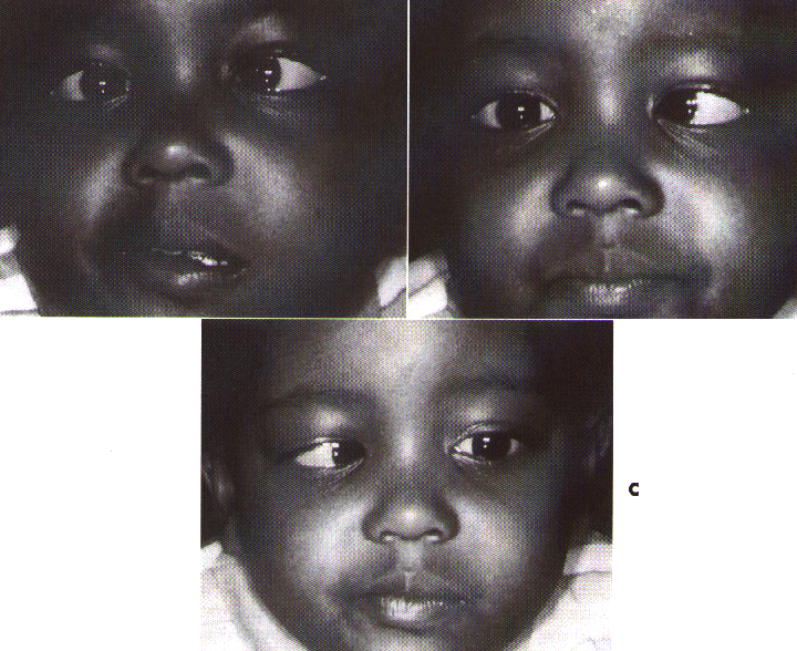 congenital_anomalies